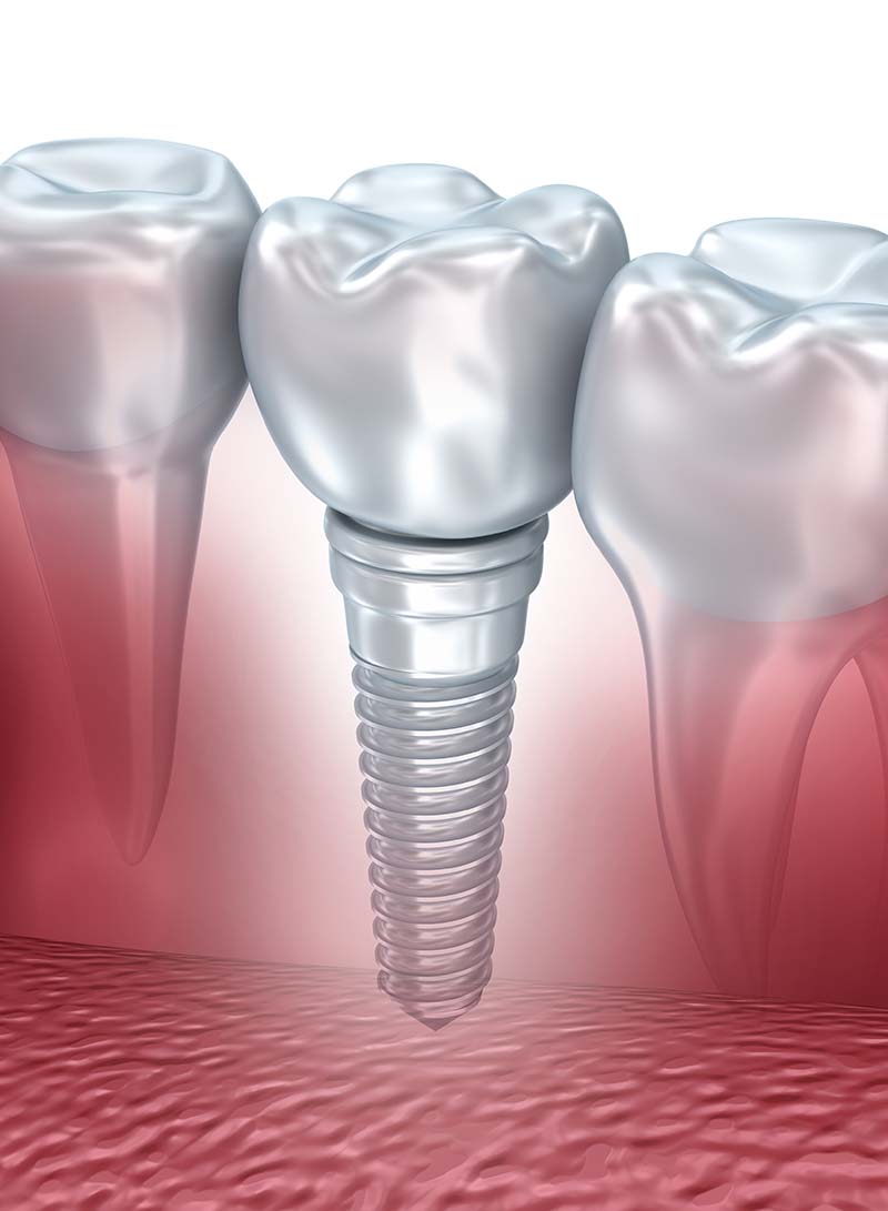 Dental Implant Illustration Image