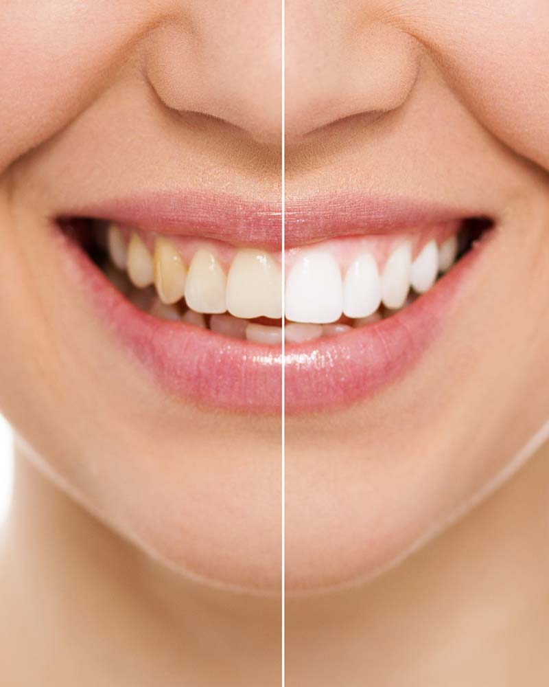 before and after teeth whitening shots side by side